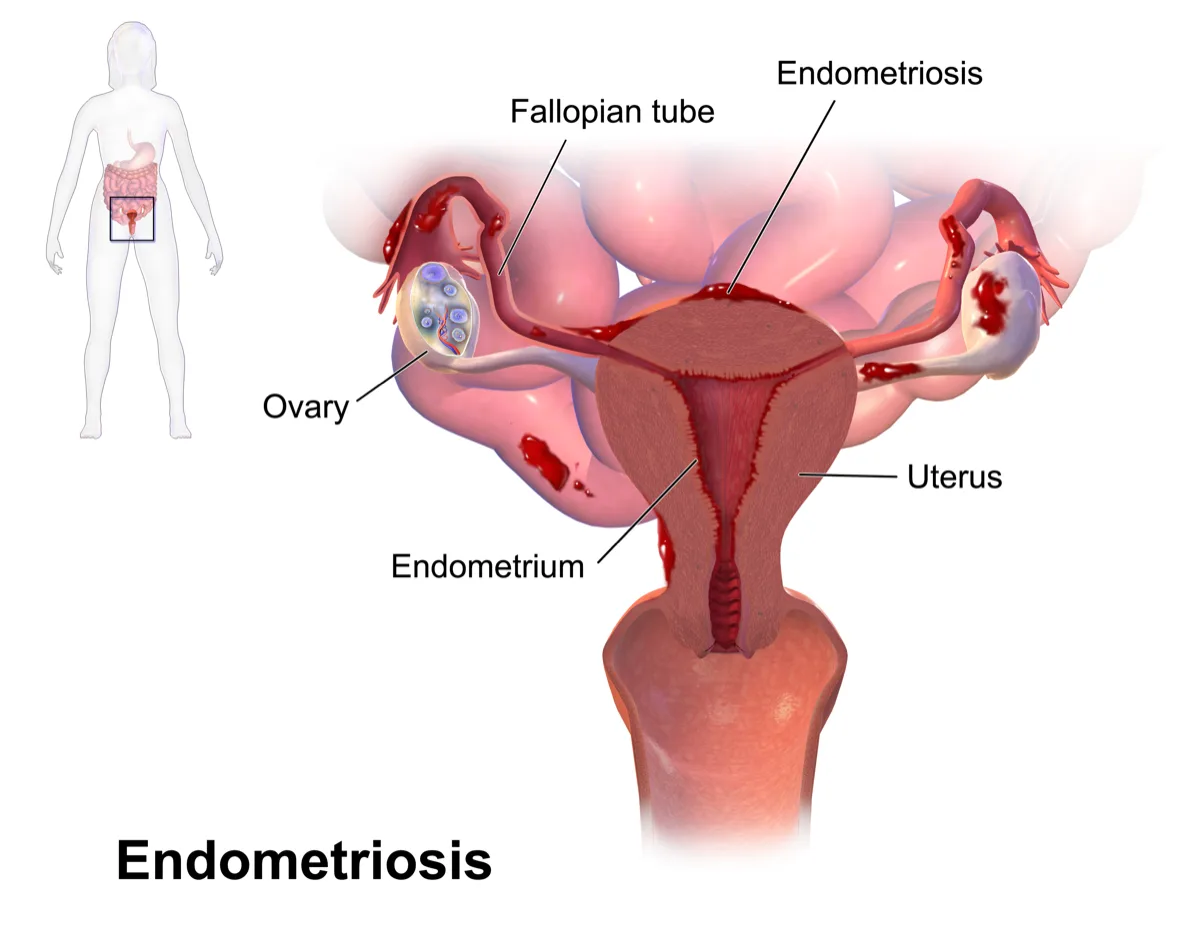 Diagram of a uterus showing endometrial tissue growing on the ovaries and outside the uterus