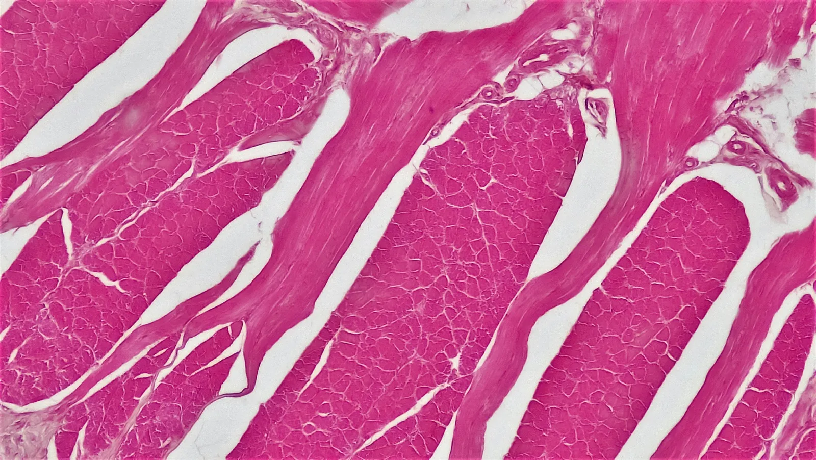 Uterine Fibroids: What Every Woman Needs to Know